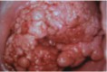 /album/fotogaleria-colposcopia/cancer-avanzado-del-cuello-de-la-matriz-jpg/